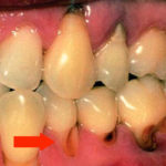 кариес корня зуба мудрости фото