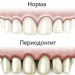 апикальный периодонтит