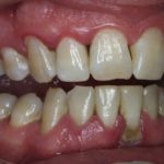 антибиотики при периодонтите