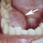 экзостоз десны после удаления зуба