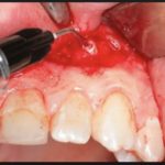 гранулированный периодонтит