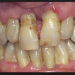 гранулированный периодонтит