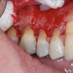 гранулирующий периодонтит