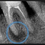 лечение каналов периодонтита