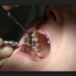 лечение пульпита молочных зубов
