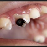 лечение зуба после пульпита