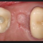 левомеколь при опухоли десен