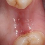 левомеколь мазать десну