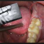 лезет зуб мудрости