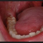 сколько лезет зуб мудрости болит