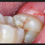 сколько лезет зуб мудрости болит десна