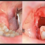 сколько лезет зуб мудрости десна