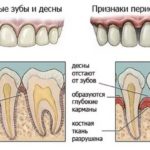 обострение периодонтита