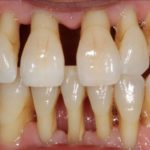 острый периодонтит