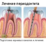 периодонтит лечение
