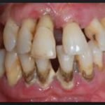 периодонтит мкб