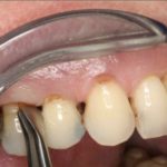 периодонтит симптомы и лечение