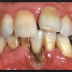 периодонтит у детей