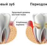 периодонтит зуба лечение