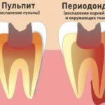 пульпит и периодонтит