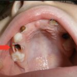 пульпит у детей молочных зубов