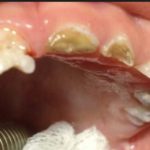 пульпит зуба у ребенка лечение