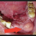 рак десны начальная стадия