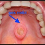 рак десны фото