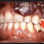 рак десны стадии