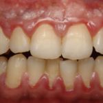 Рыхлые десны