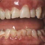 рыхлые десна кровоточат