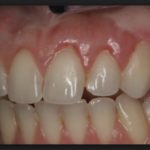 рыхлые десна у взрослого