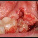 сколько лезет зуб мудрости