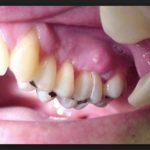 лечение свища зуба без операции