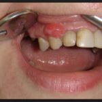 злокачественная опухоль десны