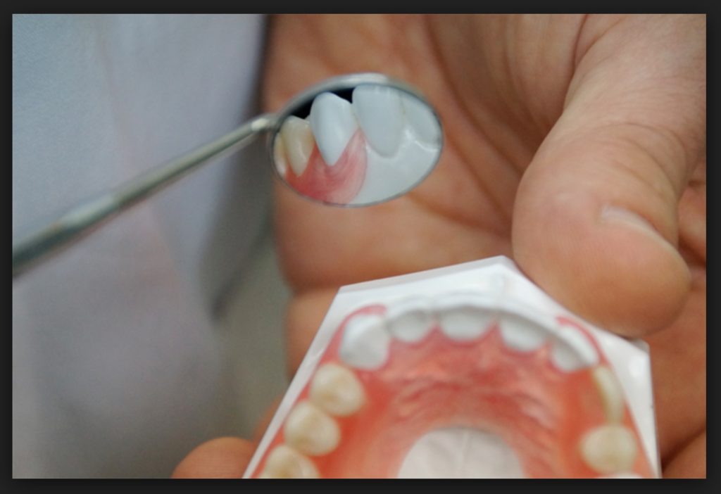 зубные протезы натерли десны