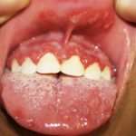 Гель Пародонтоцид