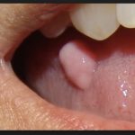 Полип на десне