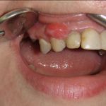 Полип на десне диагностика