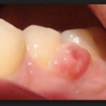 Полип на десне фото