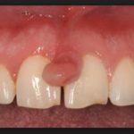 Полип на десне лечение