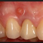 Полипы на десне