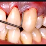 асепта адгезивный бальзам для десен