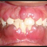 асепта адгезивный гель для десен