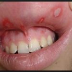 асепта гель для десен