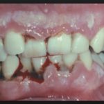 асепта гель для десен адгезивный инструкция