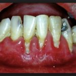 асепта гель для десен с прополисом