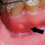 белые ранки на десне