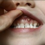 болит десна прыщ