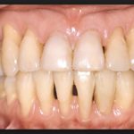 десна оголила корень зуба